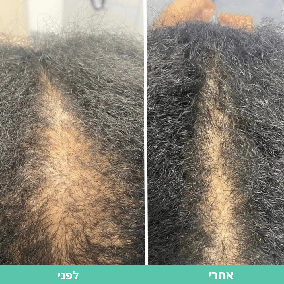 Shifaa™ סרום לצמיחת שיער