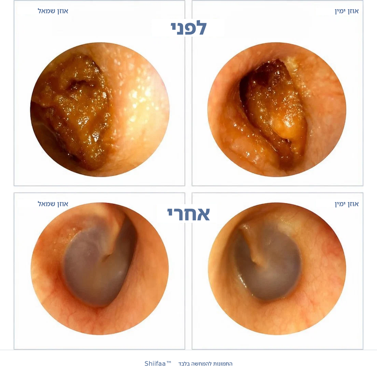 Shiifaa™ – מנקה אוזניים חכם עם מצלמת HD